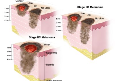 Deep melanoma