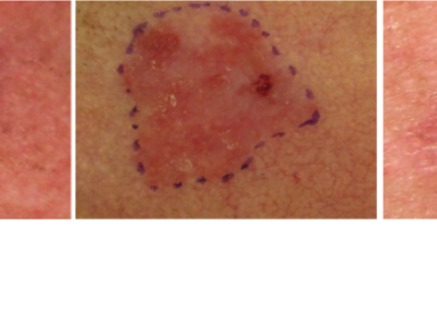 squamous-cell