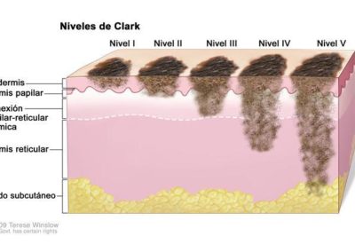 Melanoma progression